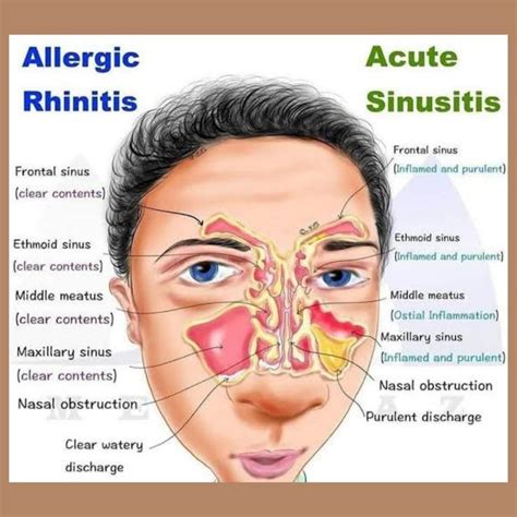 Allergic Rhinitis .